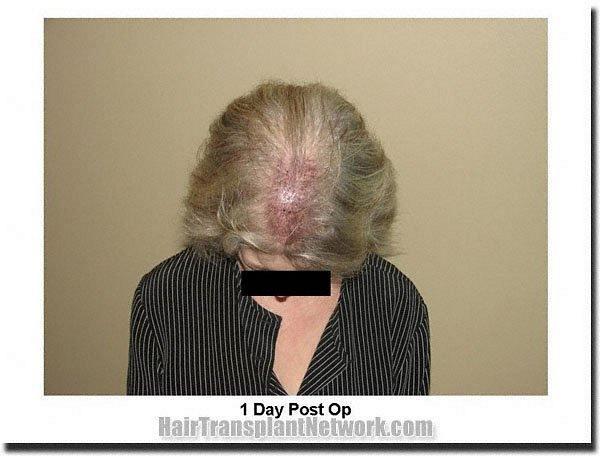 Hair restoration procedure results