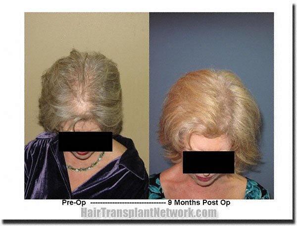 Hair restoration procedure results