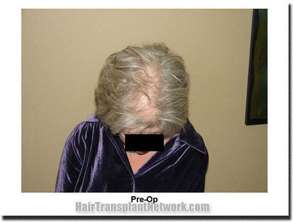 Hair restoration procedure results