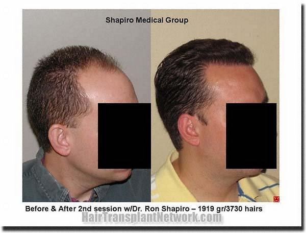 Hair restoration procedure results