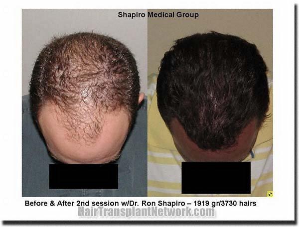 Hair restoration procedure results