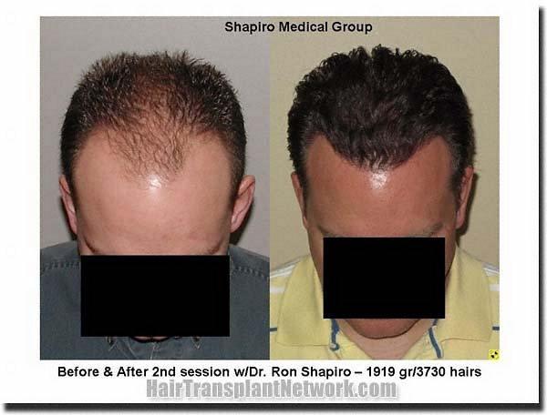 Hair restoration procedure results