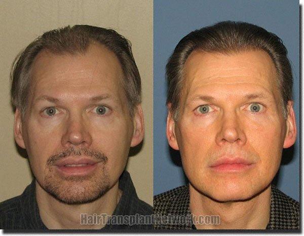 Hair restoration procedure results