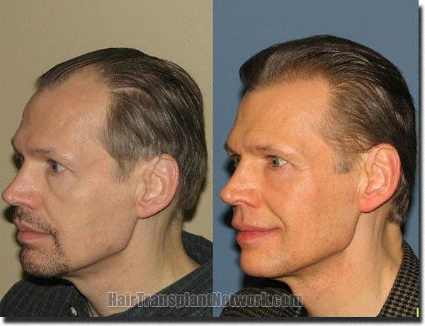 Hair restoration procedure results