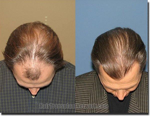 Hair restoration procedure results