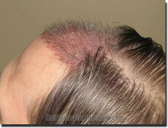 Hair restoration procedure results