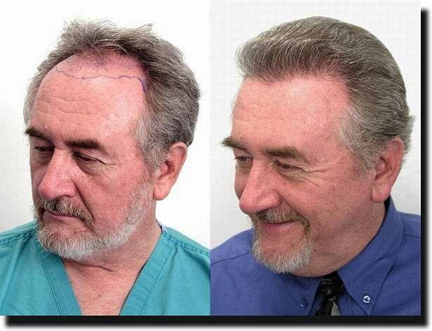 Hair restoration procedure results