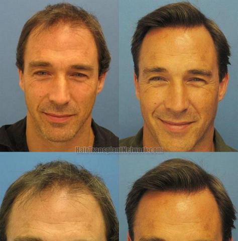 Front view - Before and after hair restoration procedure