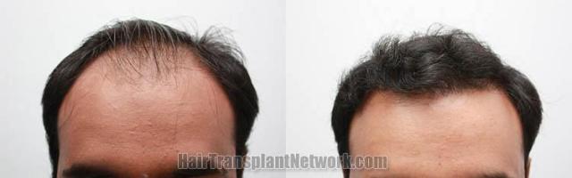 Images of hair transplantation results