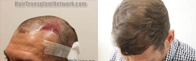 Hair transplantation surgery before and after images