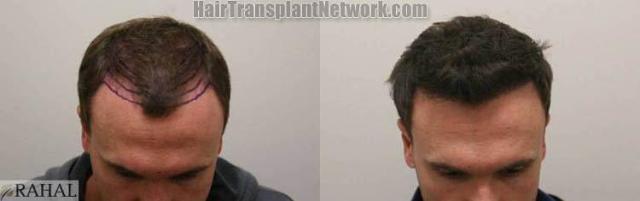 Hair restoration procedure before and after pictures