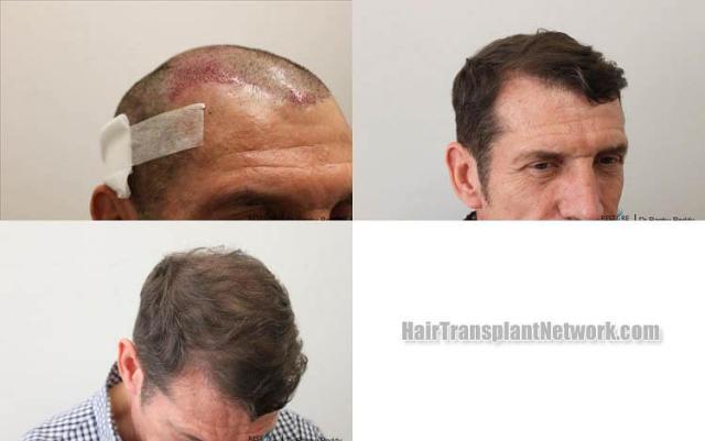 Hair transplantation surgery before and after photos