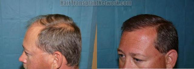 Left view before and after hair restoration pictures