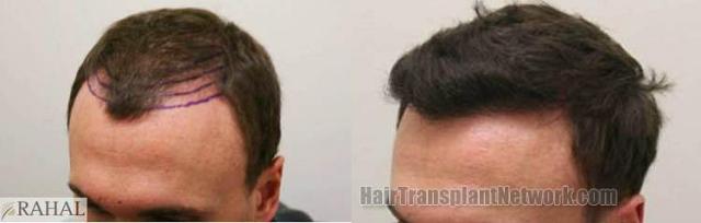 Hair transplantation surgery before and after pictures