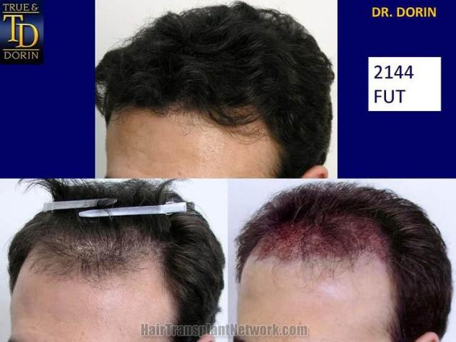 Hair replacement surgery before and after images