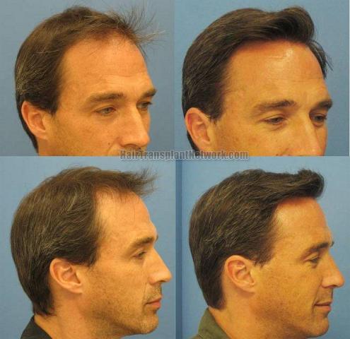 Right side and oblique views before and after hair restoration