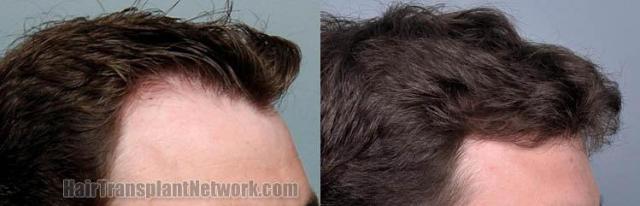 Hair restoration procedure before and after results