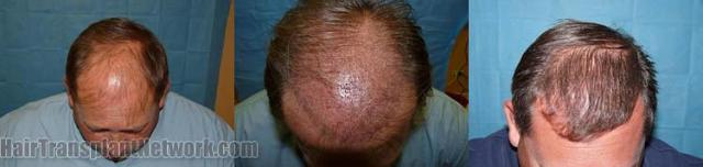 Top view before and after hair restoration procedure