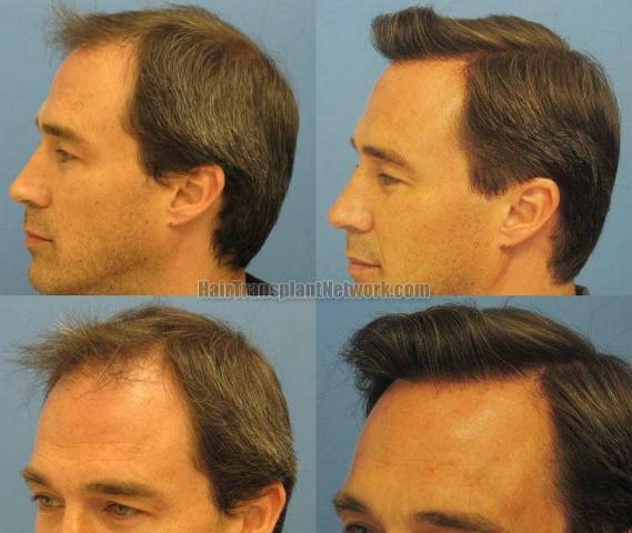 Left side before and after photos from 4692 graft hair replacement