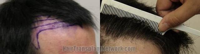 Hair restoration procedure results