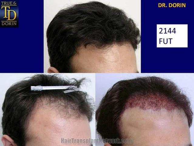 Before and after hair transplantation result photographs