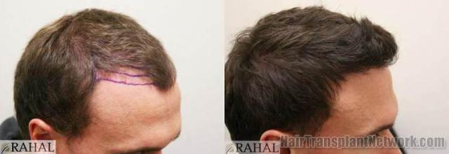 Hair restoration procedure results