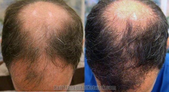 Before and after hair restoration procedure photos