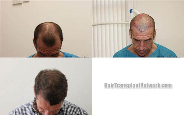 Top view - Before and after surgical hair replacement