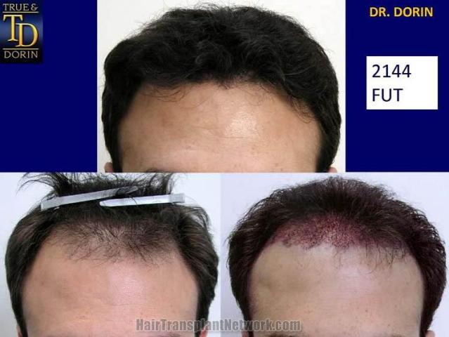 Surgical hair transplantation result photographs