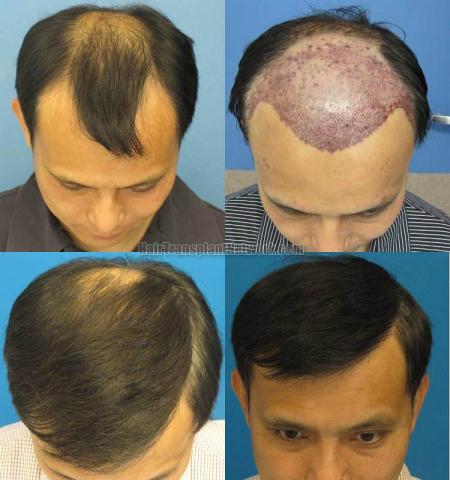 Top view before and after hair restoration images