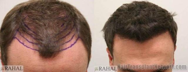 Top view before and after hair restoration results