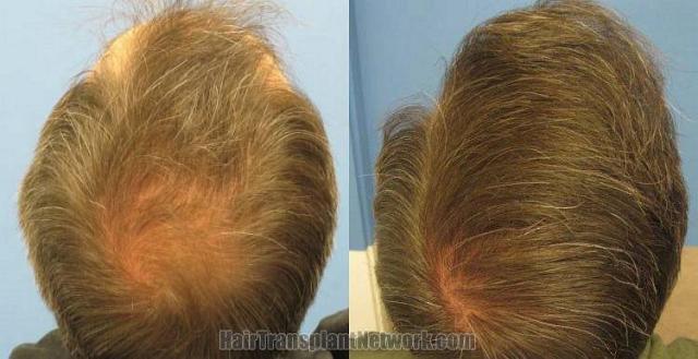 Back / Crown view before and after hair transplant