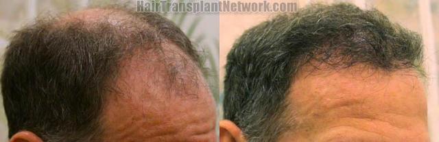 Right view before and after hair transplant procedure