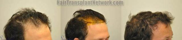 Hair restoration procedure result images