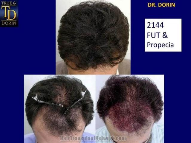 Top view - Before and after surgical hair replacement