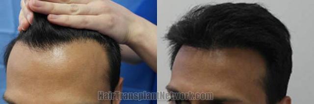 Hair transplantation surgery before and after pictures