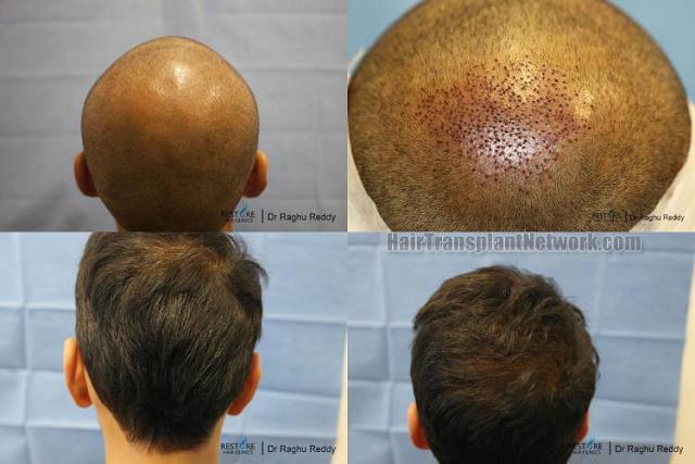 Hair restoration procedure before and after pictures