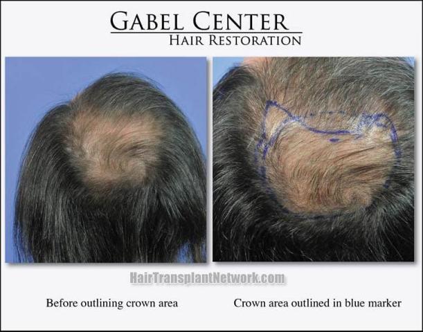 Hair transplantation surgery before and after pictures