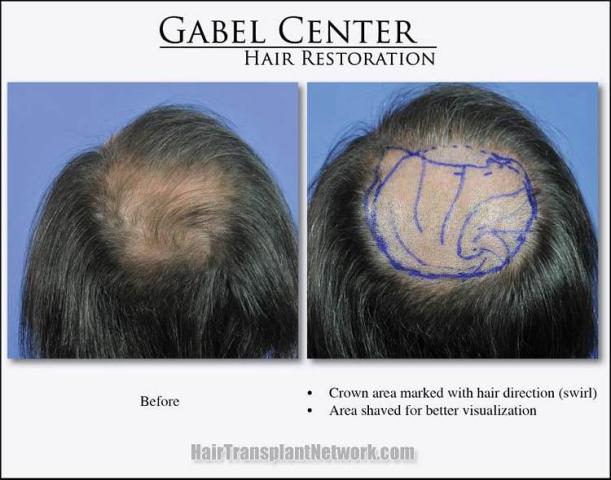 Hair restoration procedure before and after pictures