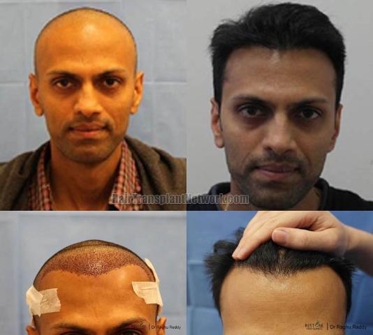 Hair restoration procedure before and after results