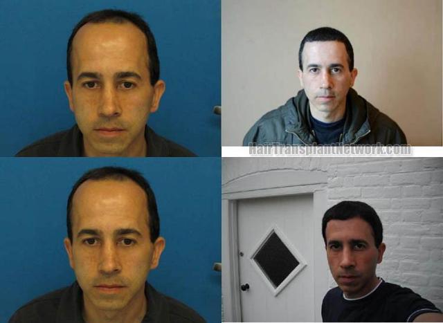 Hair transplantation surgery before and after photos