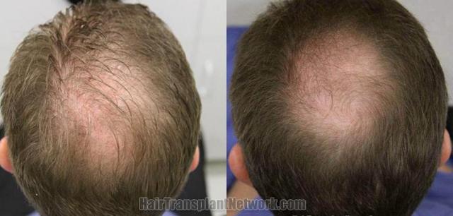 Hair transplantation surgery before and after images