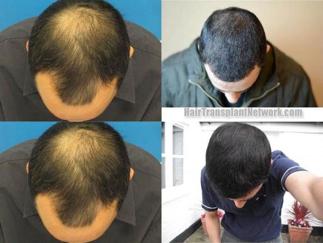 Hair restoration surgery before and after photos