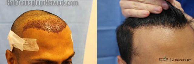 Hair transplantation surgery before and after images