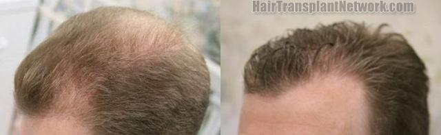 Hair transplantation surgery before and after pictures