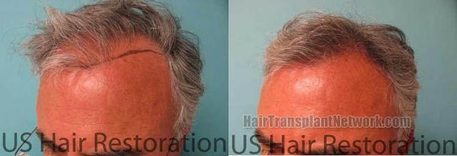 Hair transplantation surgery before and after images