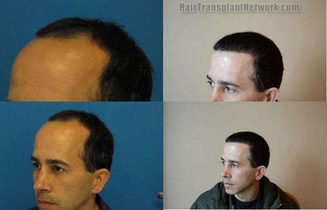 Hair restoration procedure before and after pictures