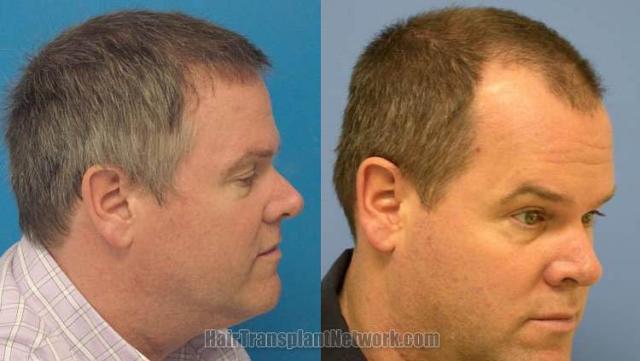 Right view before and after hair restoration images