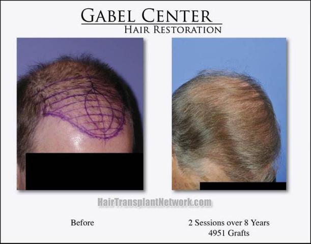 Before and after hair transplant procedure images