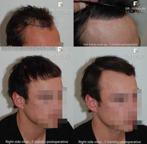 Before and after hair restoration procedure